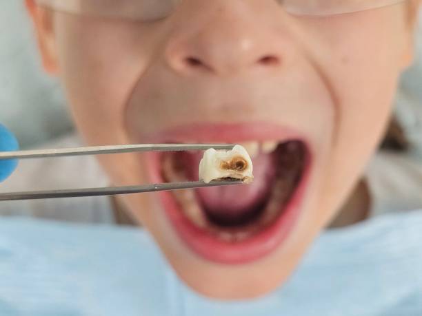Best Emergency Treatment for Dental Infections or Abscesses in Uvalde Estates, TX