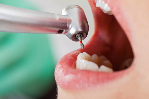 Best Emergency Tooth Extraction in Uvalde Estates, TX